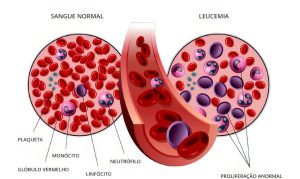leucemia