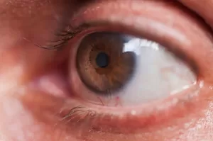glaucoma