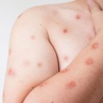 Goiás tem cinco casos de Mpox em investigação; Secretaria Municipal de Saúde reforça cuidados à população